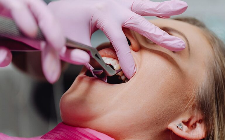 corona-dentis-zobozdravstvena-ambulanta-zobozdravnik-maribor-nasveti-02-900x600